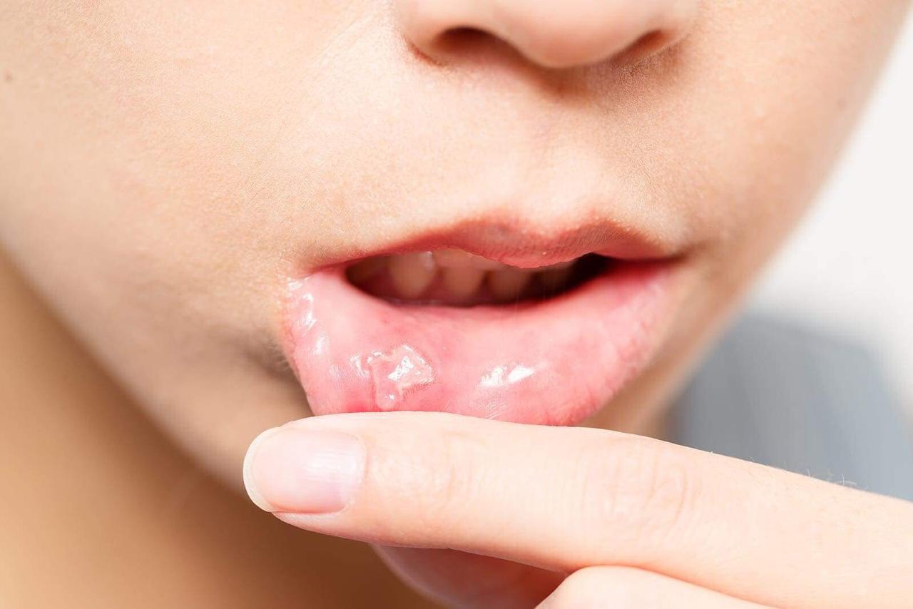 Mouth ulcers with covid