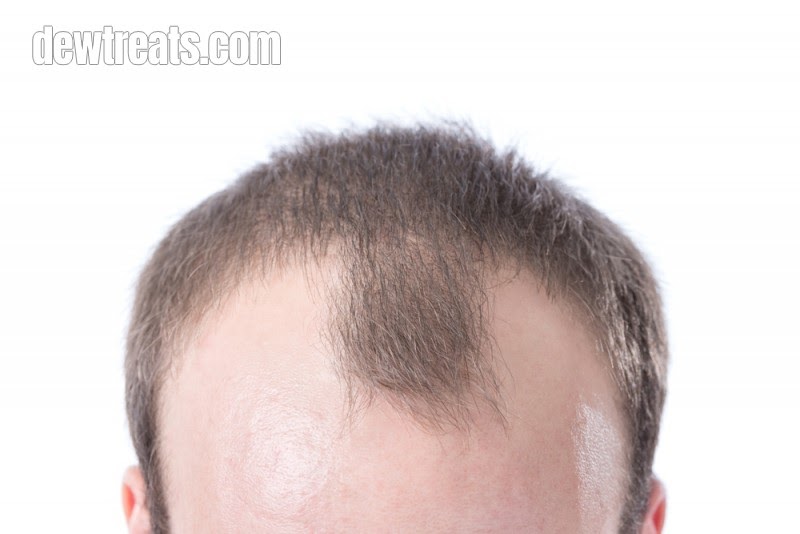 How to stop receding hairline and regrow hair naturally