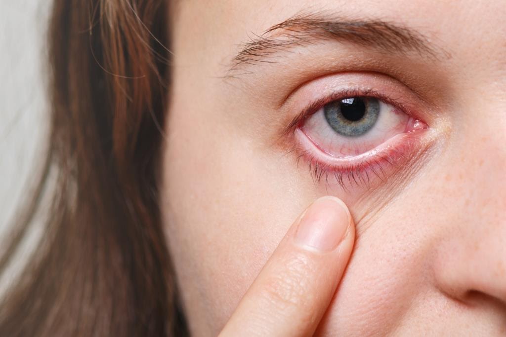 Simple home remedies for dry eyes