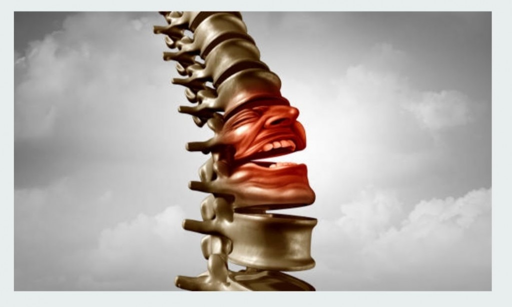 The Best 6 Home Remedies For Degenerative Disc Disease