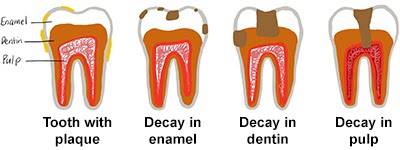 Home Remedies For Cavities