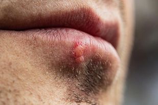 Natural remedies for cold sores