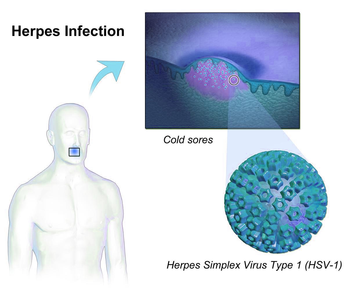 home remedies for cold sores