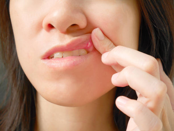 Help Canker Sores