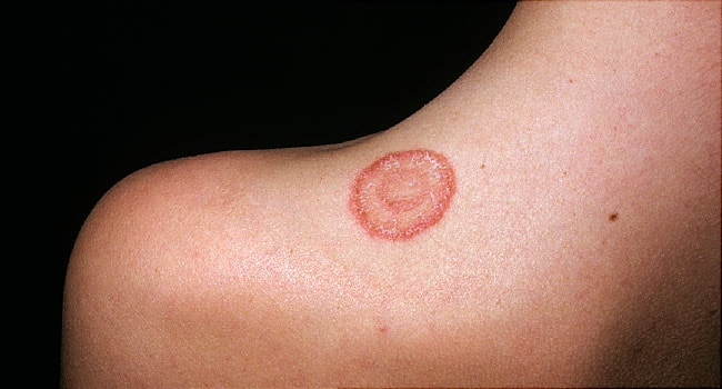 Ringworm Natural Treatment