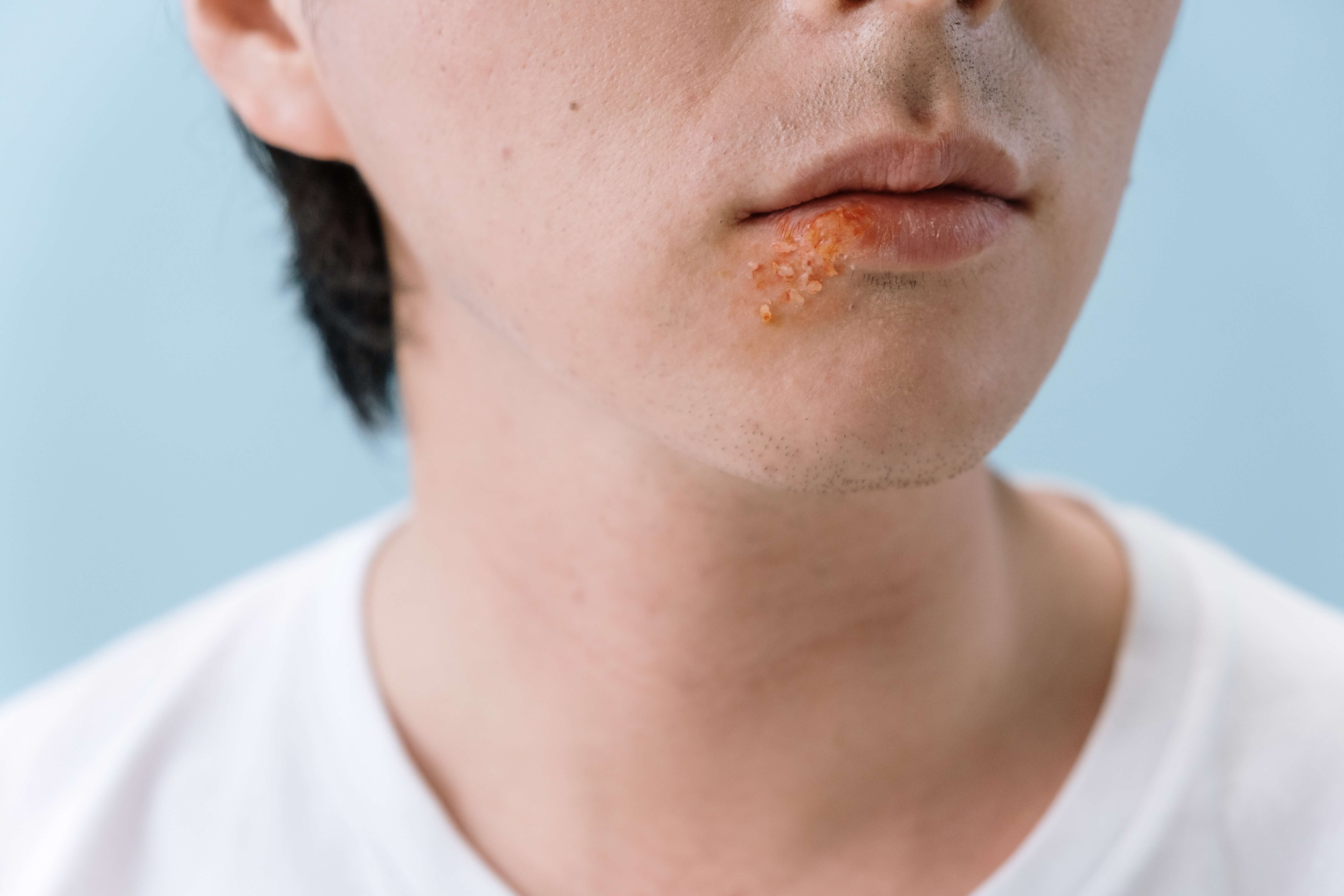 Natural Cures For cold sores