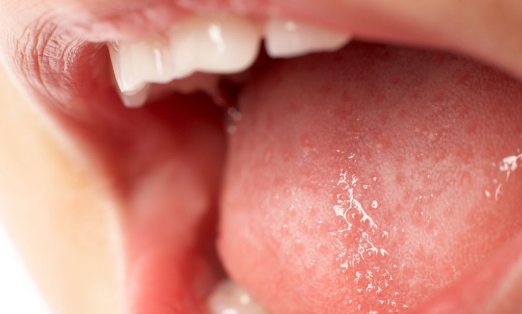 home-remedies-for-tongue-sores-the-best-6-remedies