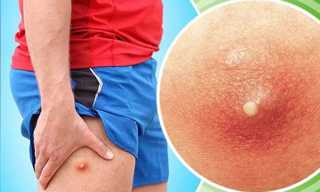 boils-on-inner-thigh-symptoms-7-home-remedies-to-use