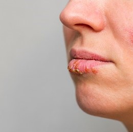 Natural Remedies For Cold Sores On Lips