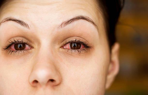 Simple home Remedies for dry eyes