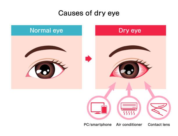 Simple home remedies for dry eyes