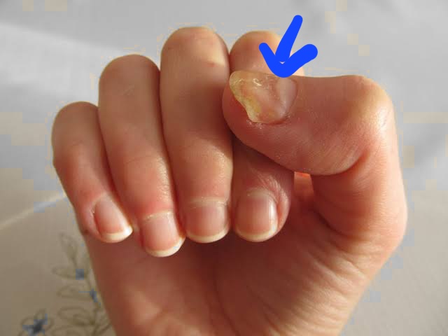 home remedies for nail fungus