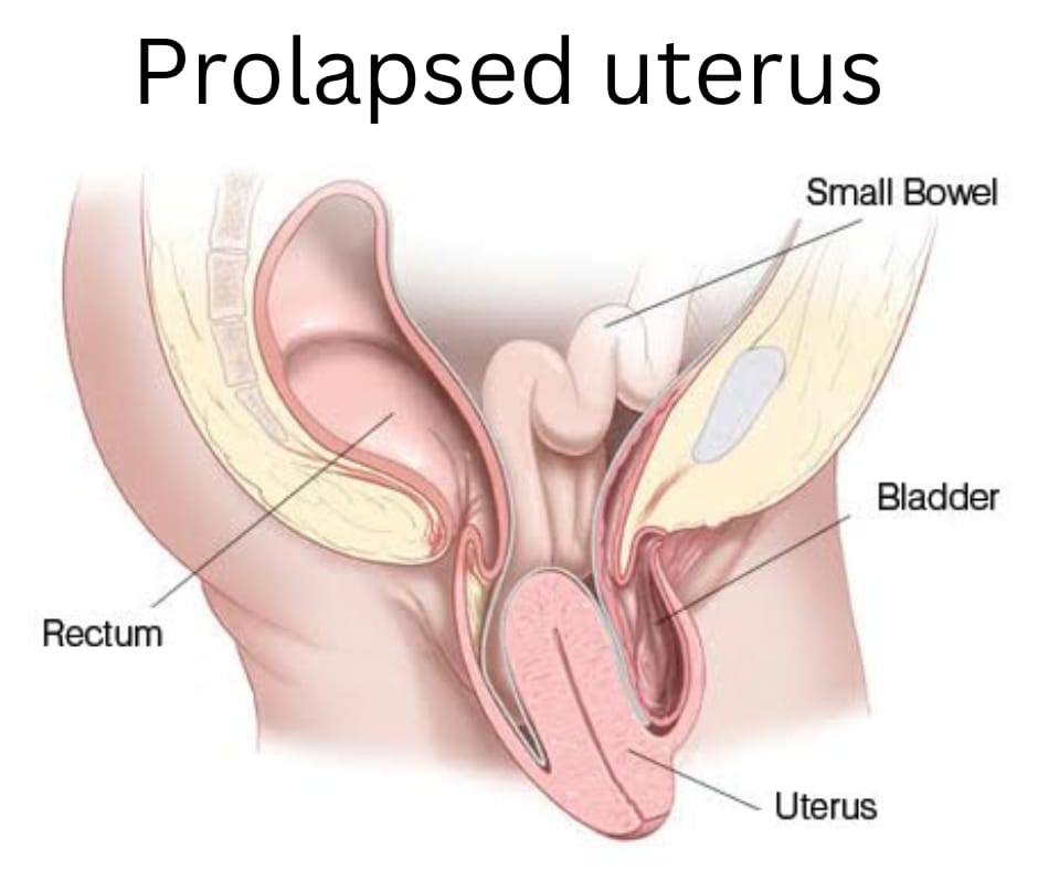 prolapse uterus bleeding 