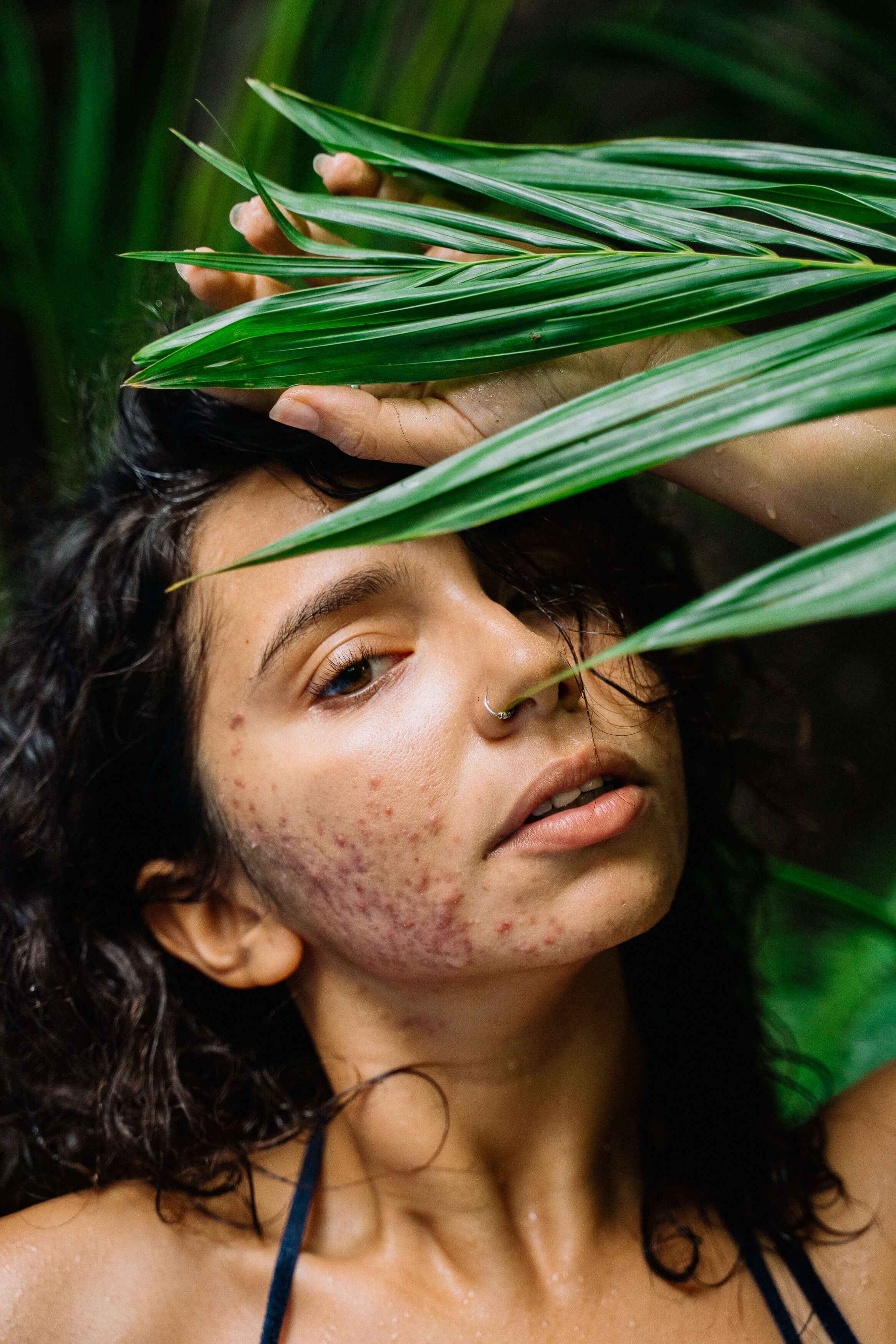 Natural remedies for pimples and dark spots