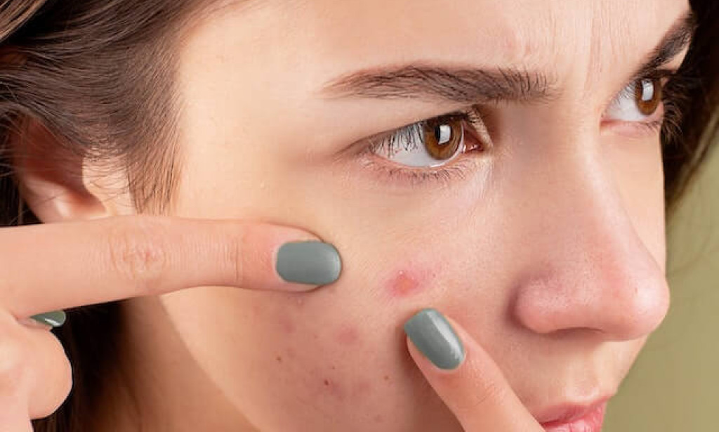 Home Remedies For Zits Under The Skin Under skin Pimple