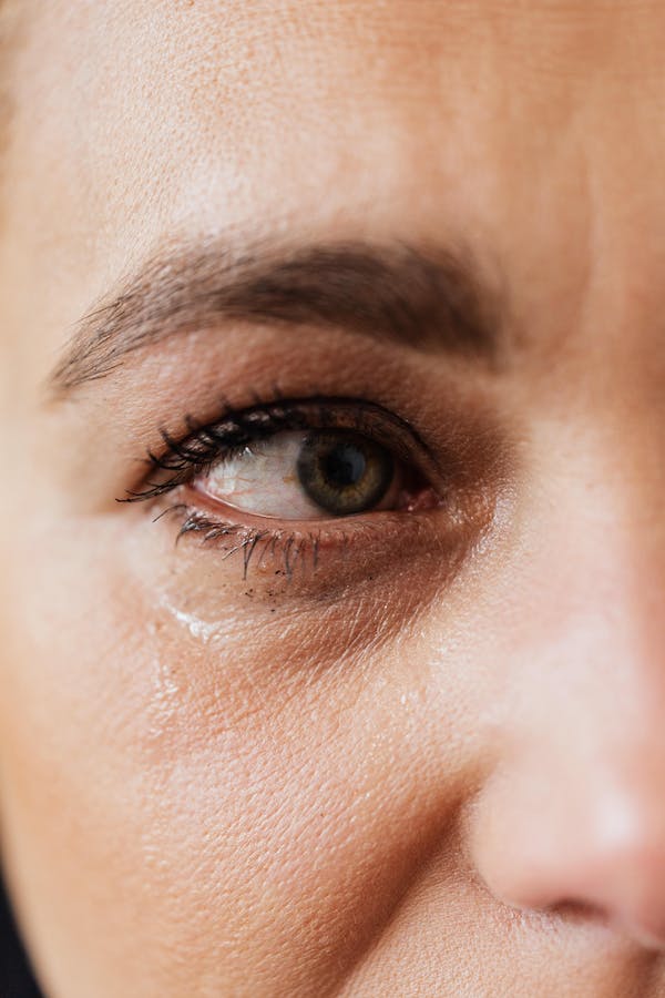 home remedies for eye redness