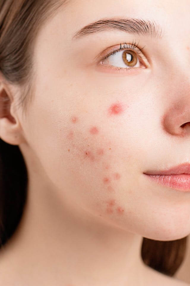 pregnancy pimples on face