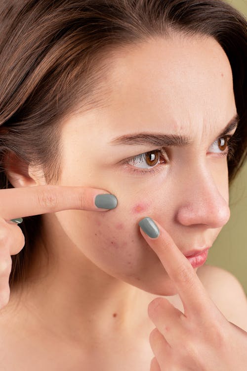 home remedies for open pores 3