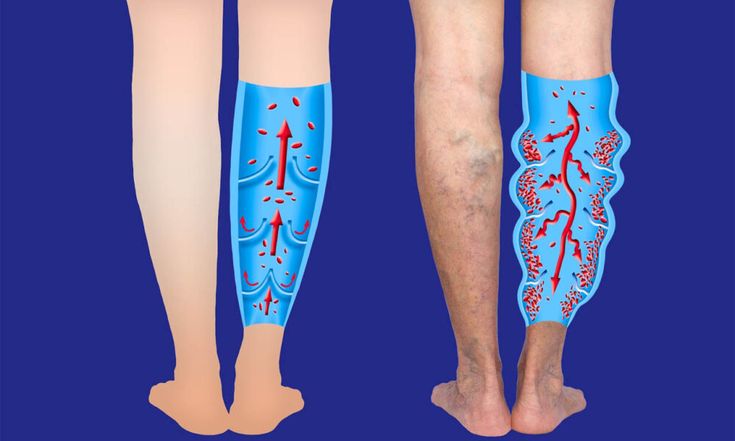 home remedies for varicose veins