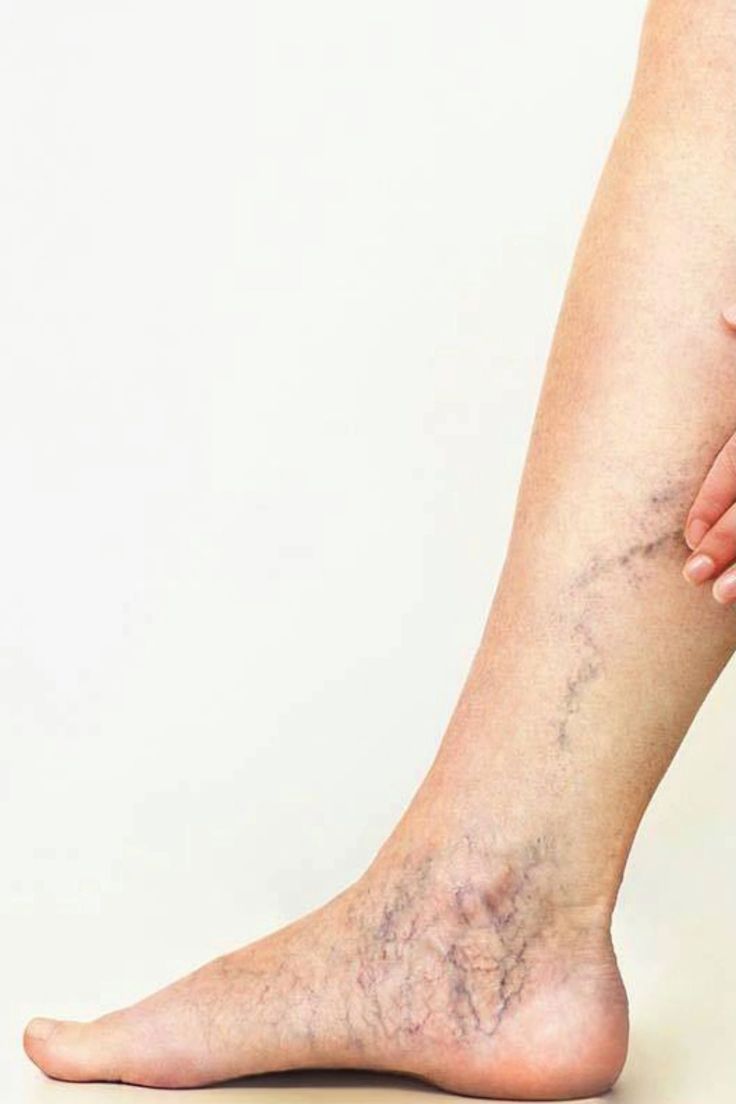 home remedies for varicose vein 3