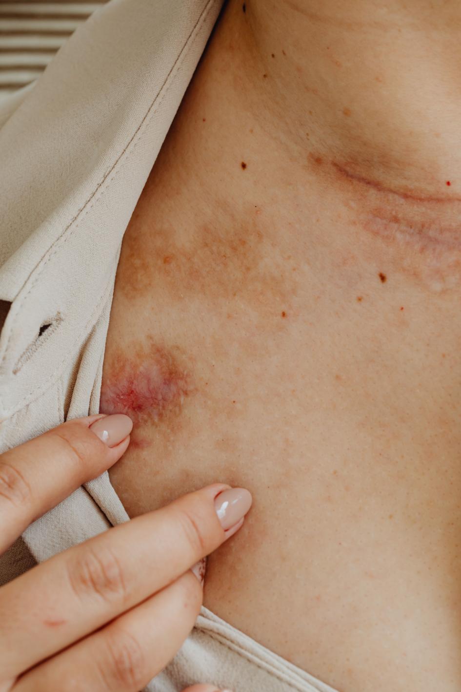 home remedies for oil burns