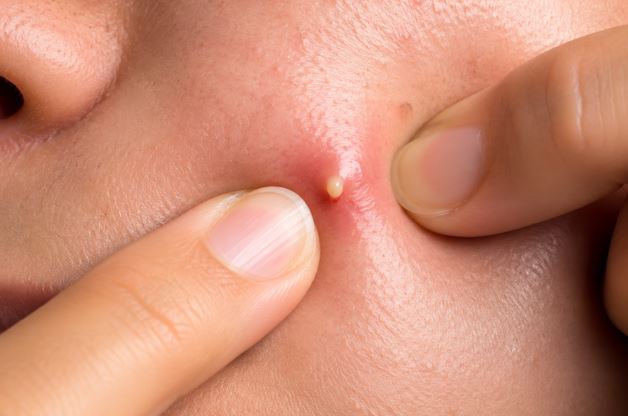 home remedies for pimples