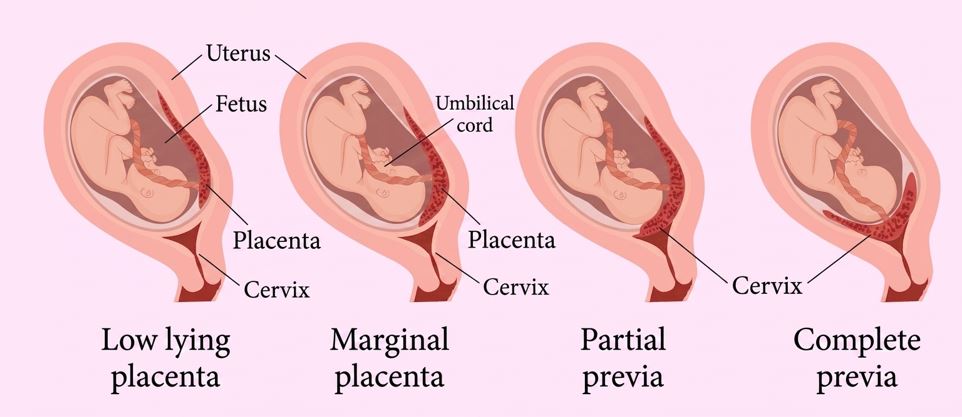 Causes of Placenta Previa Causes of Placenta Previa