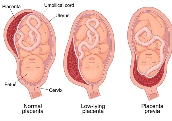 Causes of Placenta Previa Causes of Placenta Previa